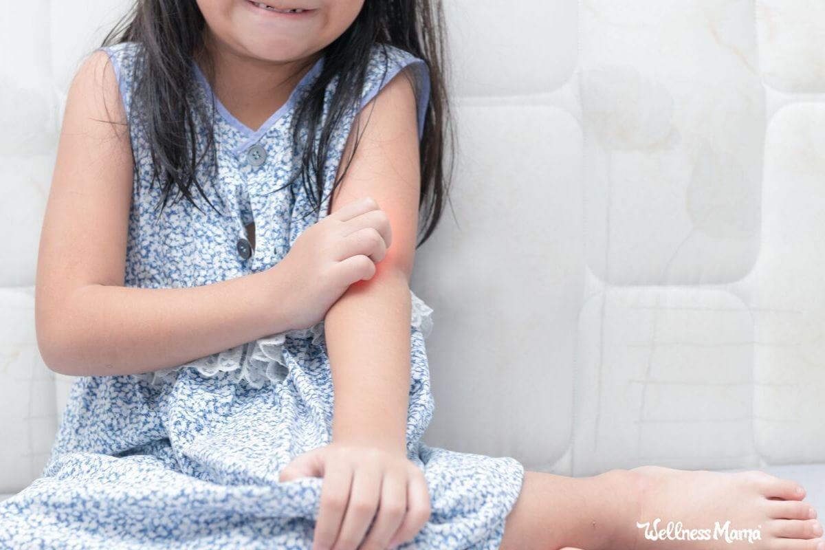 Natural Remedies for Eczema