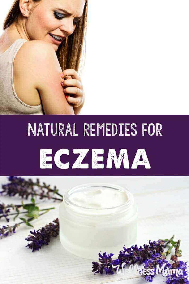 Eczema can be unbearable, especially for children. Diet is important but these natural remedies can help get rid of it once and for all!